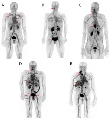Figure 2. Immuno-PET maximum-intensity-projection images recorded in five patients (one patient  of each cohort, A to E) included in the optimization part of the first-in-human immuno-PET trial using  anti-carcinoembryonic antigen CEA bispecific antibody a