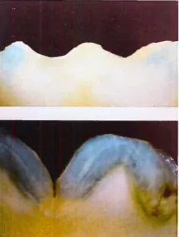 figure 2.] Fissures superficielles et profondes de Ï ‘émail. Tirée de Routet et Degrange (2000).