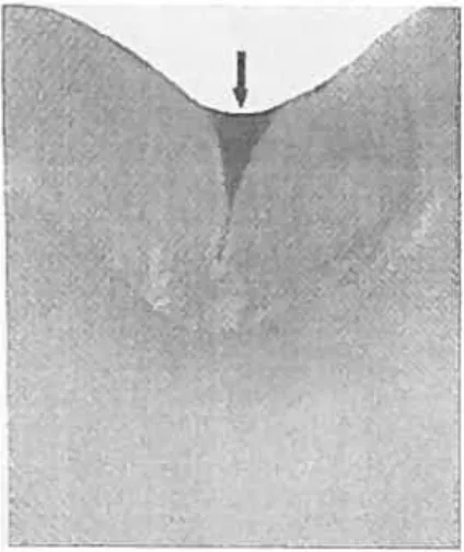 figure 2.4 . Section transversale d’une dent montrant la pénétration de Ï ‘agent de scellement au sein d’une fissure occlusale