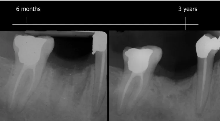 Figure 3: Radiographic of dental socket 6 months and 3 years after tooth extraction and filling  with  ICPCS