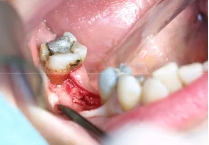 Figure 4: Clinical picture of the opened implanted area 3  years after filling the dental socket  with  ICPCS  and  just  prior  to  harvesting  the  biopsy