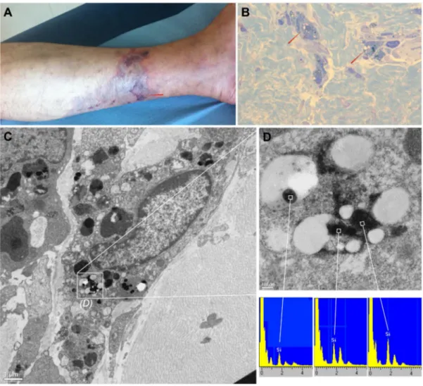 Figure 1. Macroscopic view, microscopic view and particles analysis of a representative cutaneous lesion obtained from the same patient