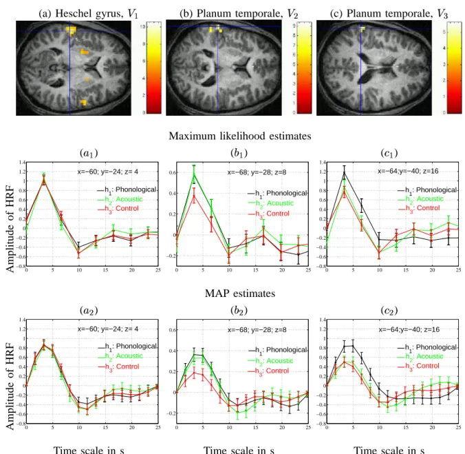 Fig. 7. Real data originating from a speech perception experiment. Top row: statistical × maps yielded by SPM 99 (thresholded at çÛ*åä FUª ), superimposed on axial slices of averaged T1-weighted images