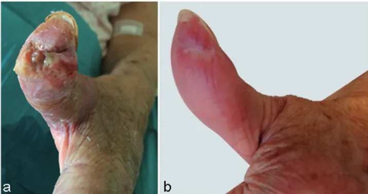 Fig. 1. (a) Sheath phlegmon of the left thumb at admission to the infectious  diseases department; and (b) evolution of the left thumb after 9 months  of tuberculosis treatment.