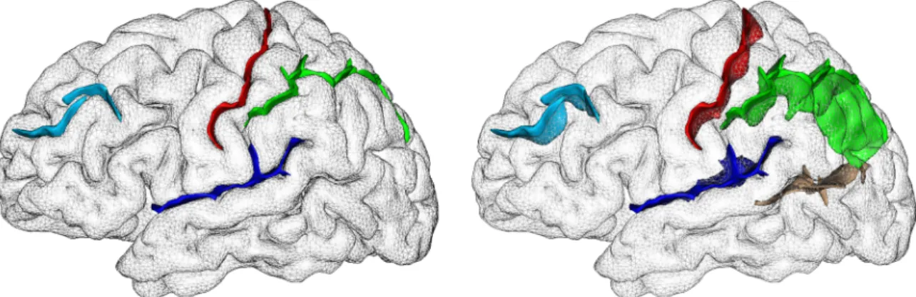 Fig. 2. Bilateral results consistent with cortical atrophy in HD: shallower central and intra-parietal sulcus in HD