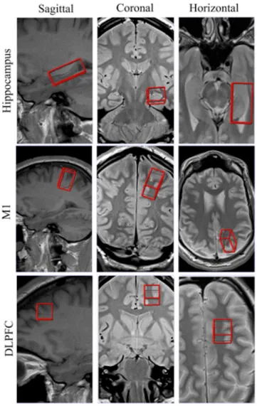 Figure  1.  Regions  of  interest  (ROI)  for  magnetic  resonance  spectroscopy  (MRS)  data  acquisition depicted in the sagittal, coronal, and axial planes, in the hippocampus (top ; 20 x  40 x 16 mm), primary motor cortex (M1, middle ; 16 x 20 x 32 mm)