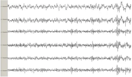 Figure 1.5: Temporal evolution of a typical EEG signal. Each line represents one channel.