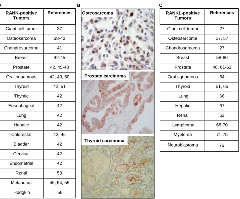 Figure 2 Osteosarcoma Prostate carcinoma Thyroid carcinomaB   46, 54, 55Melanoma53Renal42Endometrial42Cervical42Bladder42, 46Colorectal42Hepatic42Lung42Eosophageal42Thymic42, 51Thyroid42, 49, 50Oral squamous42, 45-48Prostate 42-45Breast41Chondrosarcoma38-4