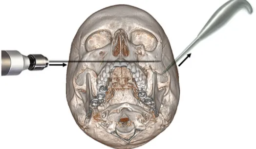 Fig 1. Representation of the CRWF technique. The broken zygomatic bone (left cheek) is maintained reduced with a Ginestet hook thanks to an upward pull, while the Kirschner wire is introduced into the corpus of the healthy side (right cheek) and pushed thr