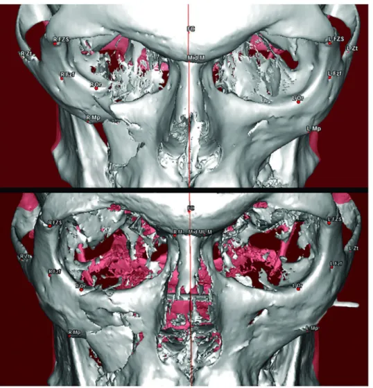 Fig 4. Three-dimensional reconstruction of the CT scan and the cone beam CT in a patient with a right tetrapodal ZMC fracture treated by the CRWF technique, preoperatively (top), and postoperatively (bottom) showing good reduction of the fracture.