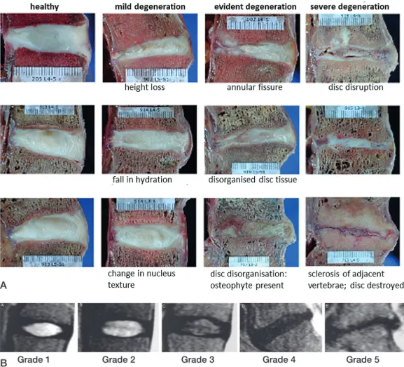 Figure 3. A. Sagittal sections of human lumbar intervertebral discs at various stages of degeneration