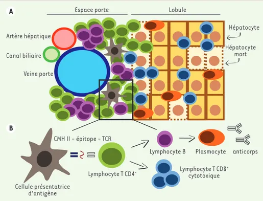 Figure 1. Représentation schématique de l’infiltrat lymphocytaire du foie dans l’hépatite auto- auto-immune