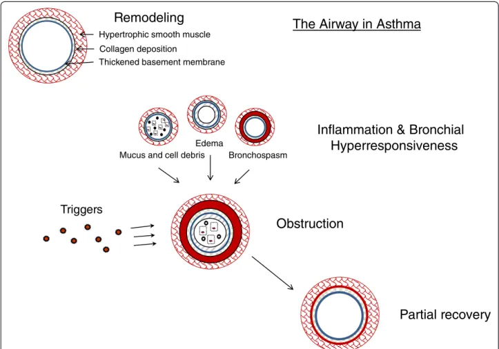 Figure 2 Pathophysiology of asthma at steady state and during an exacerbation. The airways of asthmatic individuals are characterized by pathological changes, including thickened basement membrane, collagen deposition and hypertrophic smooth muscle, collec
