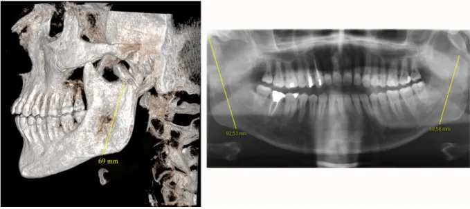 Figure 1 : Ascending ramus height measurement on CBCT three-dimensional reconstructions (left) and on  panoramic X-ray (right)