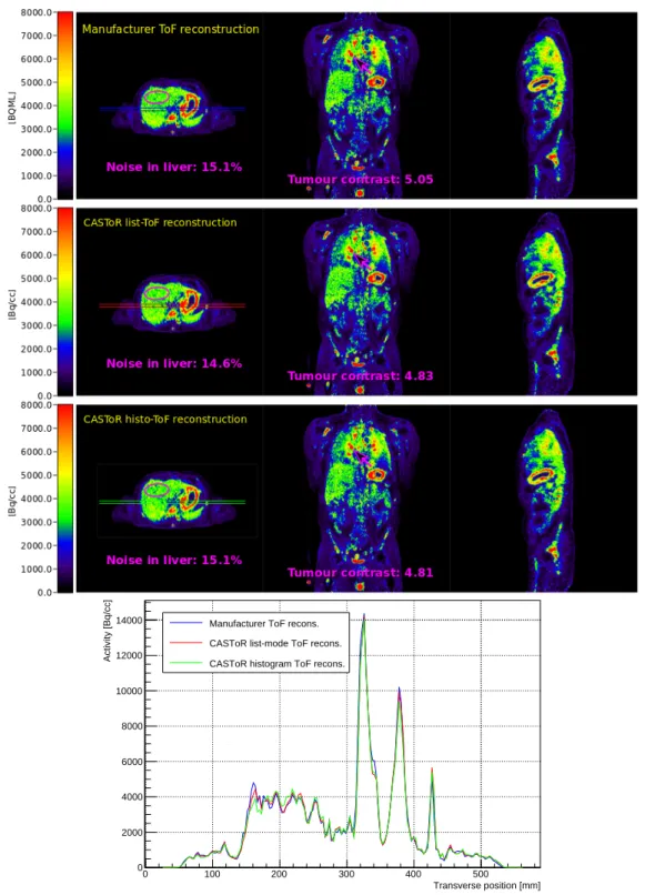 Figure 5. Whole-body [ 18 F]-FDG data set acquired on a SIGNA PET/MR system with (top) manufacturer (middle) CASToR list-mode and (bottom) CASToR histogram reconstructions including TOF information (see text for details)