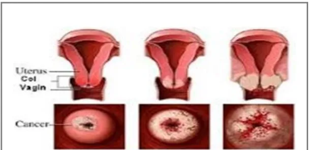 Figure 6 : Développement  de cancer col de l'utérus (Khenchouche A., 2014).  