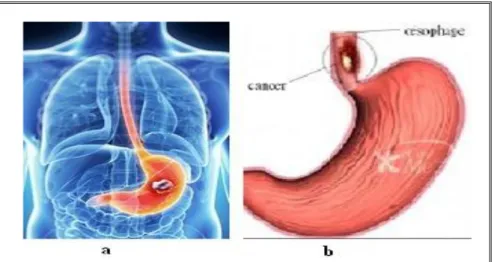 Figure 10 : a Situation de cancer d'estomac b Aspect anatomique  de cancer l'œsophage (Azzi, R., et al, 2013)