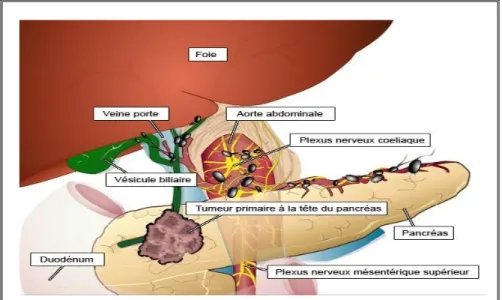 Figure 11 : Tumeur primitive de pancréas (Dürr ,D., et al, 2013). 