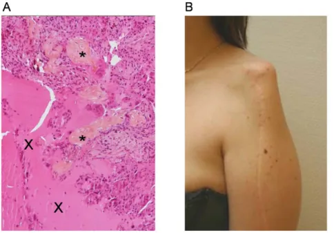 Figure 1. Telangiectasic osteosarcoma and post surgical defect. (A) Photomicrograph of the initial telangiectasic osteosarcoma showing proliferation of neoplastic cells, focal osteoı¨d formation (*) and telangiectasic space containing blood (X) (optical mi