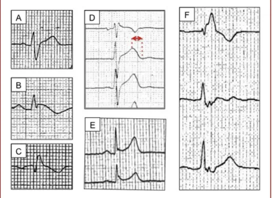 Figure 2. The main electrocardiogram (ECG) variables associated with prognosis in Brugada syndrome