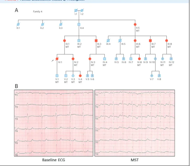 FIGURE 1 Familial Catecholamine-Induced QT Prolongation