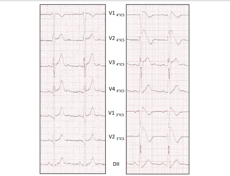 FiGURe 1 | Ajmaline testing reveals the Brugada eCG pattern. ECG pattern is recorded at 1 mm/10 mV and 25 mm/s