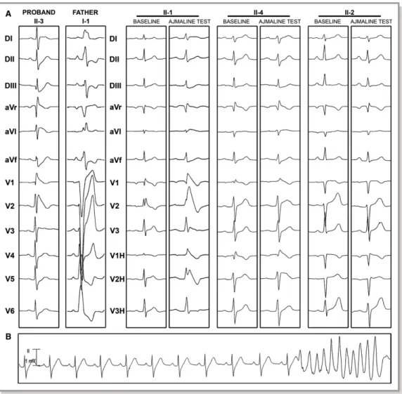 Figure 2. Electrocardiographic patterns of family members. A, Twelve-lead electrocardiograms of the proband and his relatives at baseline or/and during ajmaline test