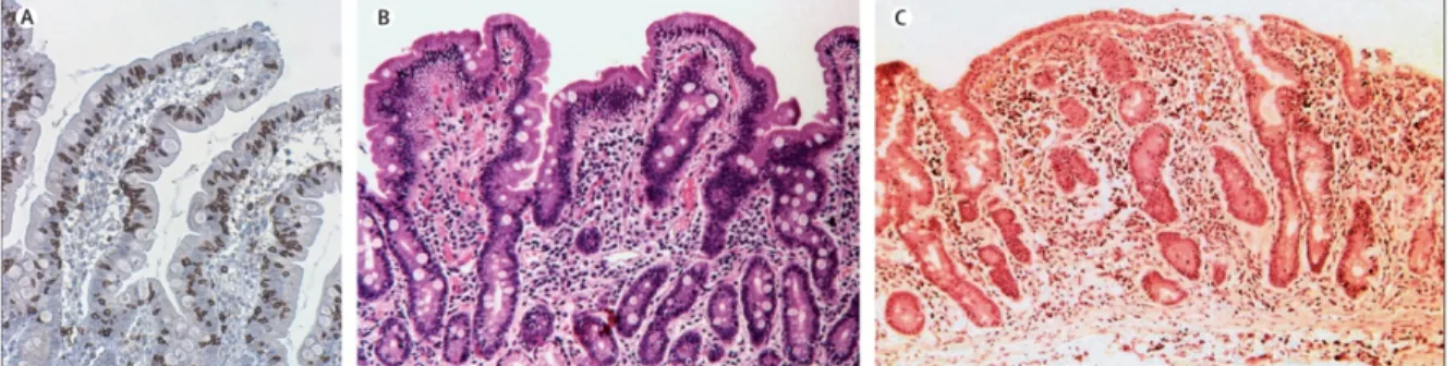 Figure 1-1. Grades A, B1, et B2 de la maladie cœliaque. Images représentatives des  différents grades de l’atteinte histologique dans la maladie cœliaque (Di Sabatino et al