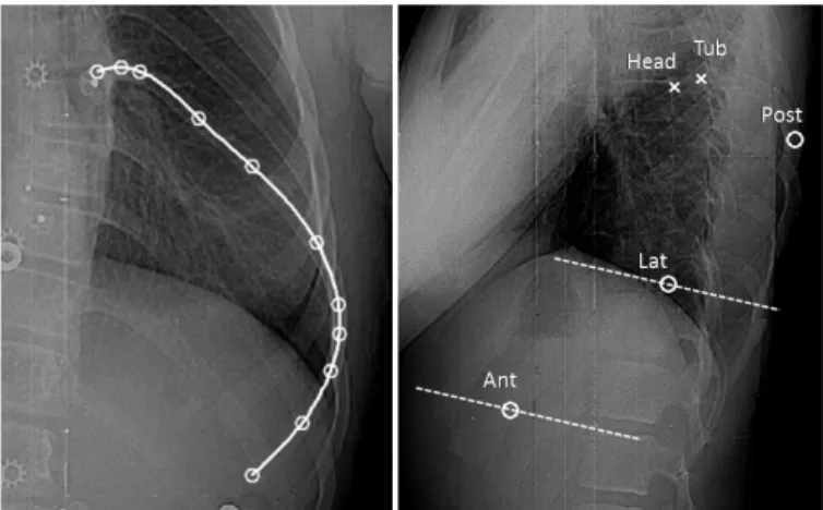Fig.  3  –  On  the  left:  rib  midline  identification  in  the  PA:  11  points  (white  circles)  are  manually  identified  along  the  rib  midline  then  a  cubic  spline  is  fitted along the 11 points