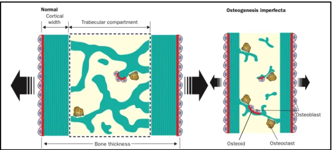 Figure 2: “Summary of histological bone abnormalities in OI : Osteogenesis imperfecta bone has a smaller than  normal external size (bone thickness) because of sluggish periosteal bone formation