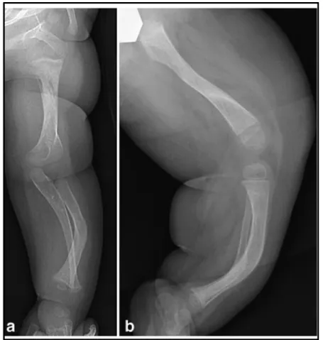 Figure 3: “Bowing of the radius (a) and tibia (b) in a baby with OI type III” [10] 