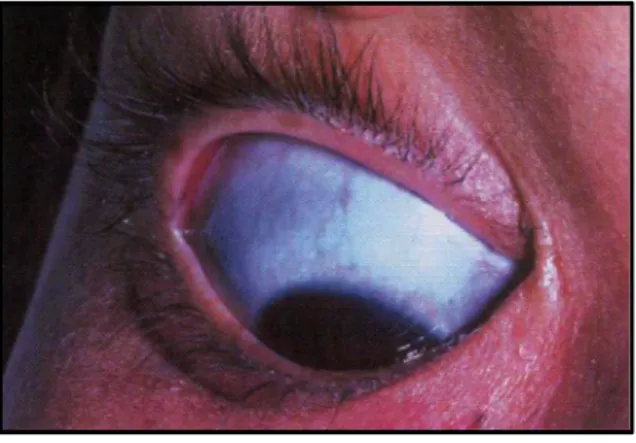 Figure 5: Blue Sclera [14] 