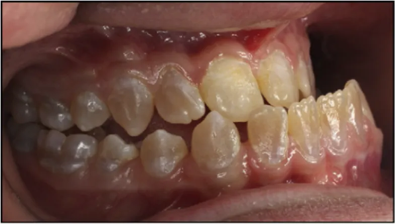 Figure 7: OI patient exhibiting Class III malocclusion, anterior openbite, lateral posterior crossbite and opalescent  teeth [27] 