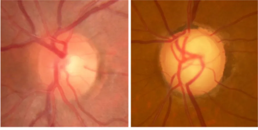 Figure 1. –   Glaucomatous optic neuropathy is characterized by the progressive deformation and  excavation of tissues at the optic nerve head