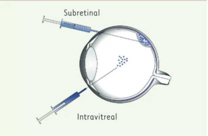 Figure 2. Voies d’injection du vecteur : sous-rétinienne ou  intra-vitréenne.