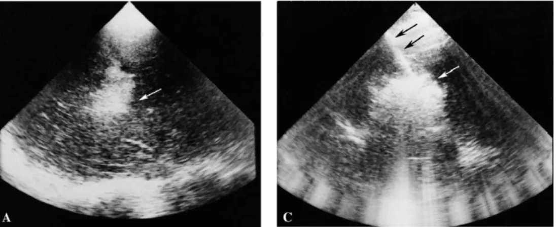 Fig. 2.4 Illustration of radio-frequency ablation procedure guided by ultrasound imaging (Chagnon et al., 2001)