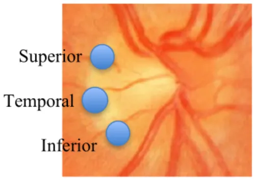 Figure  2.    Fundus  of  right  eye  showing  three  areas  where  oxygen  saturation  were  measured
