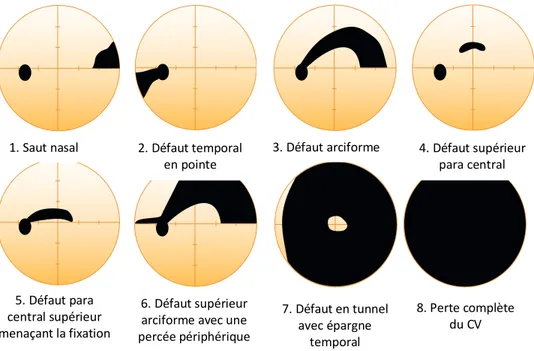 Figure 9 :   Types  de  défauts  de  champ  visuel  associés  au  glaucome  (adapté  de  Visual  field  testing for glaucoma - a practical guide ) 48