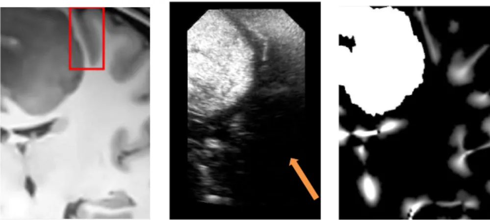 Figure 4: Patient 3 . Left: the denoised MR image corresponding to US image (Middle). Right: the probability map based on M Lvv operator and extracted from denoising MR image