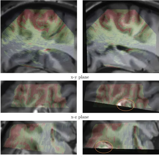 Figure 5: Patient 1. Left : registration given by the neuronavigation system.