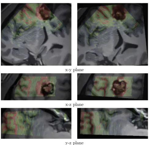 Figure 6: Patient 2. Left : registration given by the neuronavigation system.