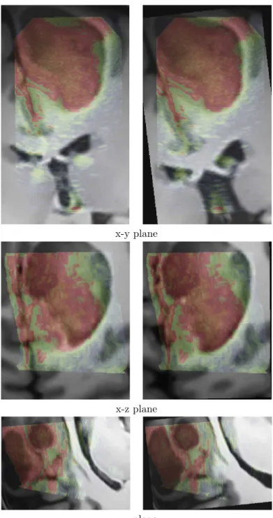 Figure 7: Patient 3. Left : registration given by the neuronavigation system.