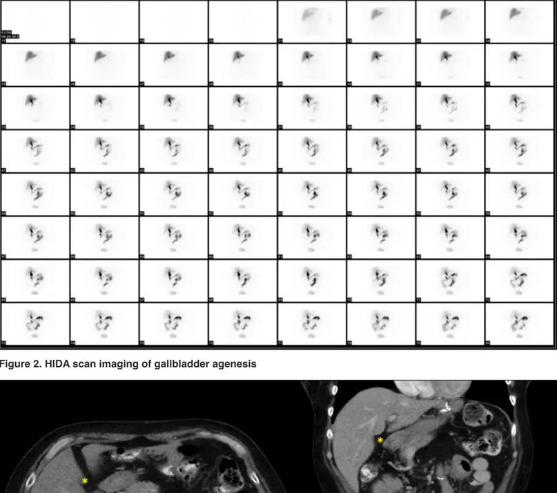Figure 2. HIDA scan imaging of gallbladder agenesis