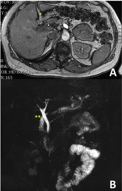 Figure 4. MRCP imaging demonstrating gallbladder  agenesis.  (A) T1 axial view. Star (*) represents the lack of  gall-bladder in the normal gallgall-bladder fossa