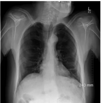Figure 5. Post-operative Chest X-ray. In contrast to the pre-op imaging, the stom- stom-ach is no longer in the thorax