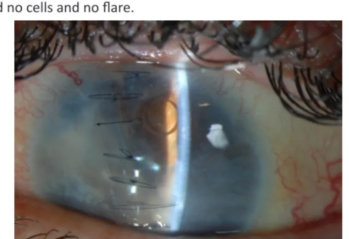 Figure 1: Left eye of a patient following primary closure and a vitrectomy  with silicone oil infusion.