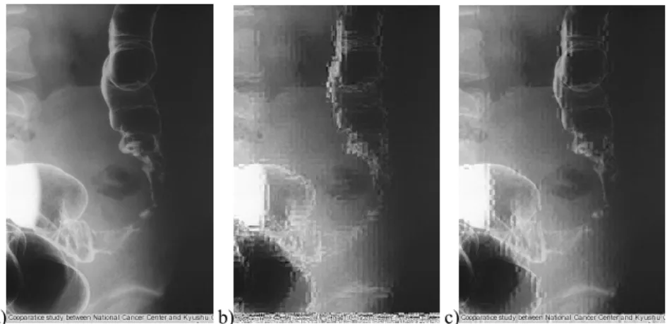 Figure 10.9. From left to right: original medical image of a colon cancer, 320x496 pixels; 