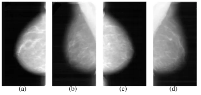 Fig. 7. Mammographic image sequence of the same patient. (a) and (b) are two views of the left breast, (c) and (d) are two views of the right one.