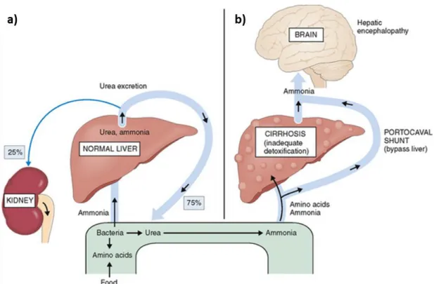 Figure 1.  Schematic illustration of ammonia cycle in human body of a) normal liver, b) in the case  cirrhosis where the liver cannot degrade the entering ammonia