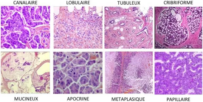 Figure 4 : Aspect morphologique des tumeurs du sein selon leur sous-type histologique